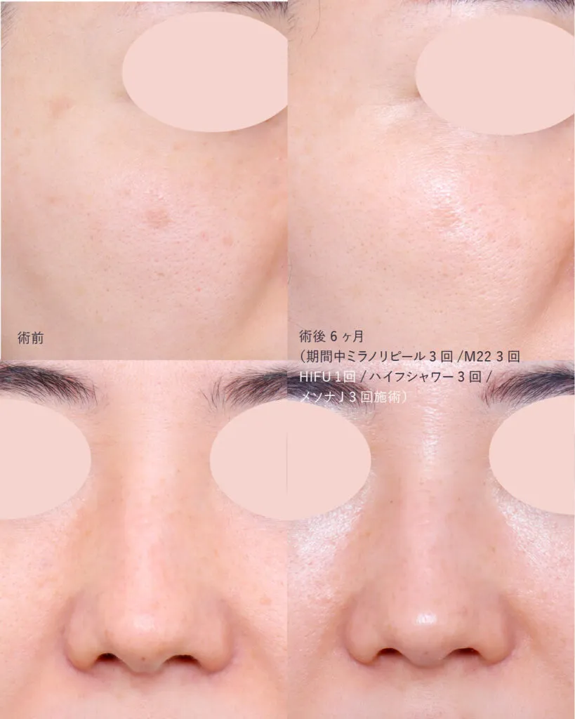 カスタマイズ肌治療の症例