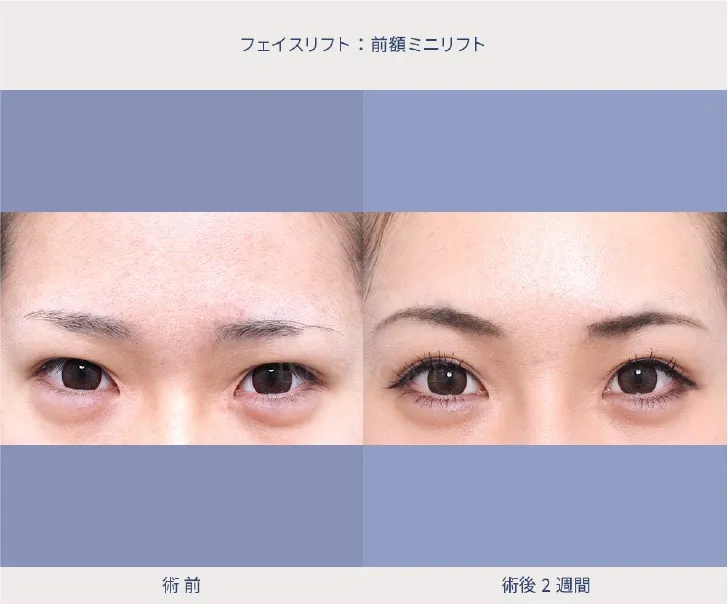 前額リフトの女性の症例