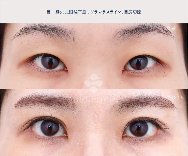 鍵穴式眼瞼下垂の女性の症例