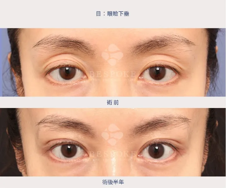 眼瞼下垂の女性の症例