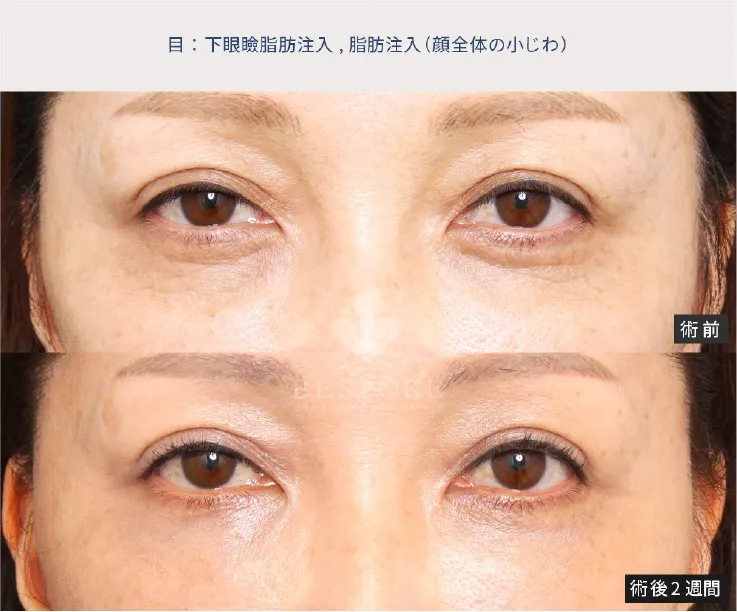 下眼瞼脂肪注入の女性の症例