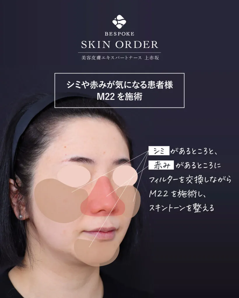 カスタマイズ肌治療（ビスポークオーダー）の症例