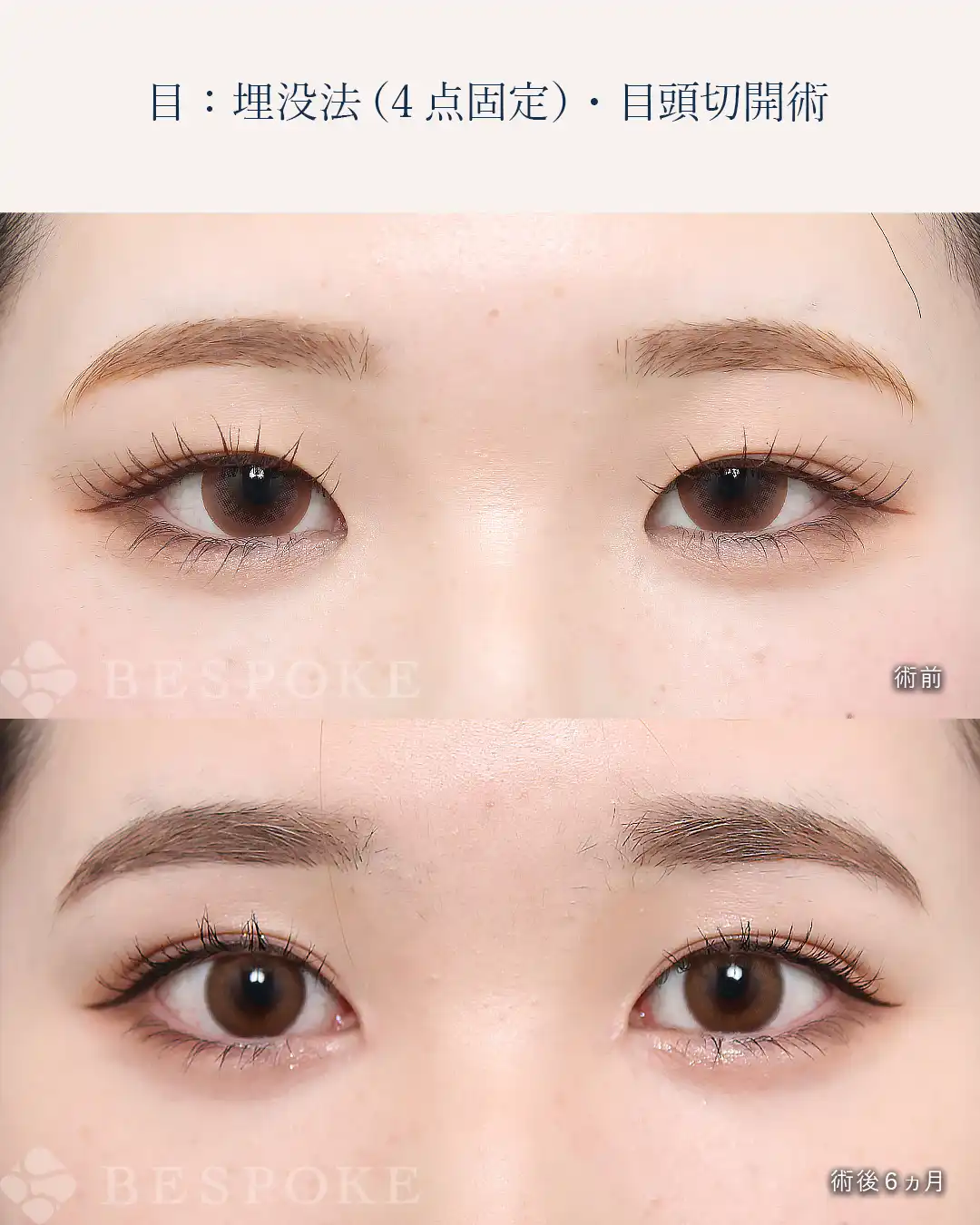 【埋没法＋目頭切開術】理想の二重を引き出す、目頭切開術