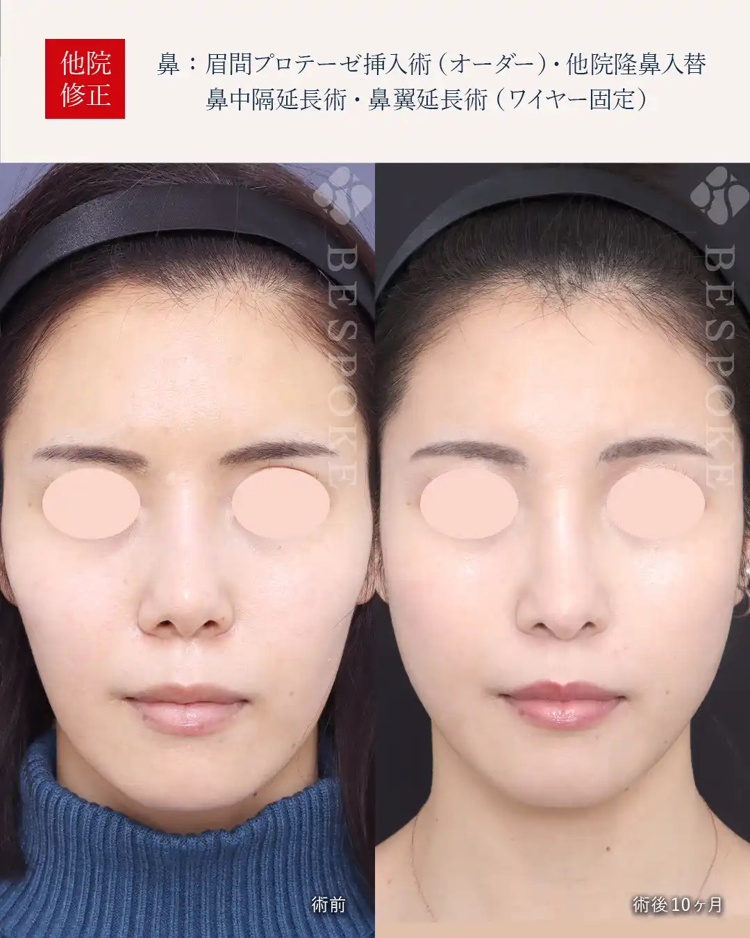 【鼻】流行を追わない美人顔