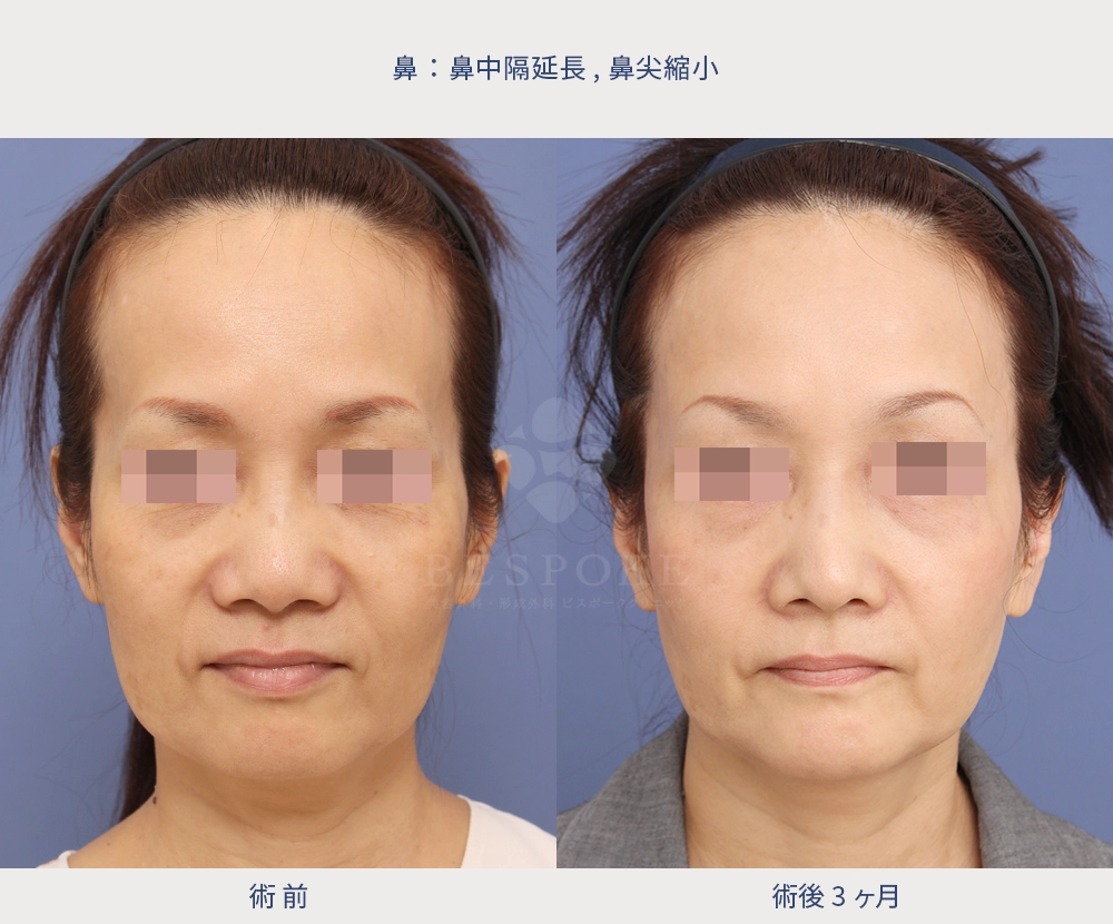 鼻中隔延長・鼻尖縮小の女性の症例