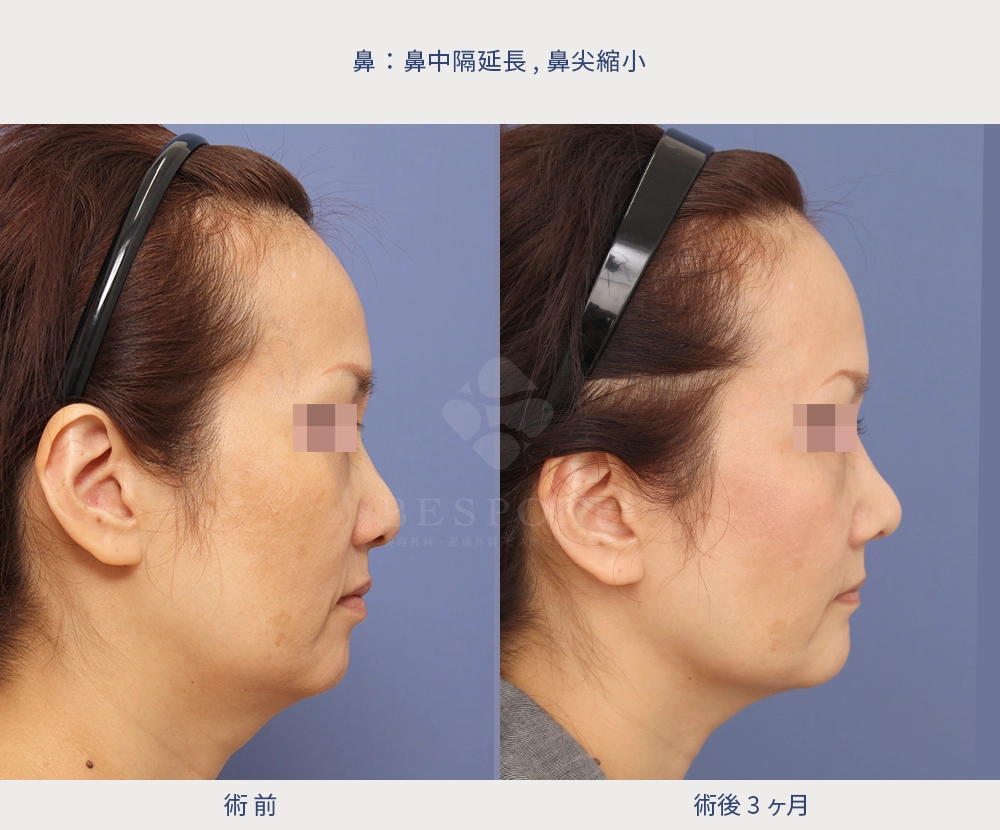 鼻中隔延長・鼻尖縮小の女性の症例
