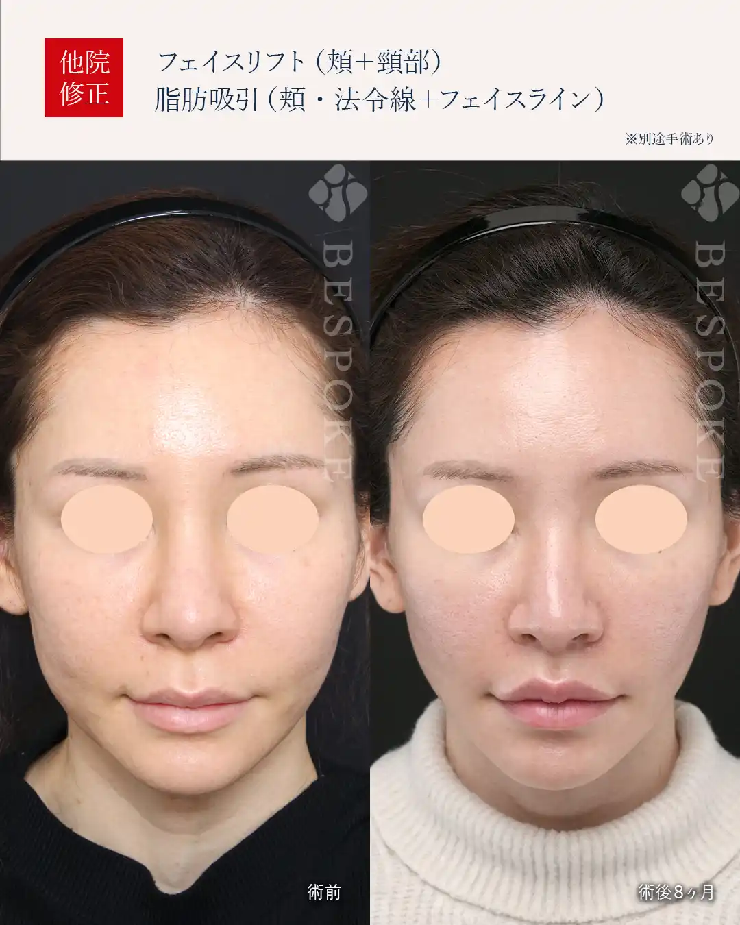 【フェイスリフト＋脂肪吸引】頬の凹凸改善とフェイスラインのたるみ改善
