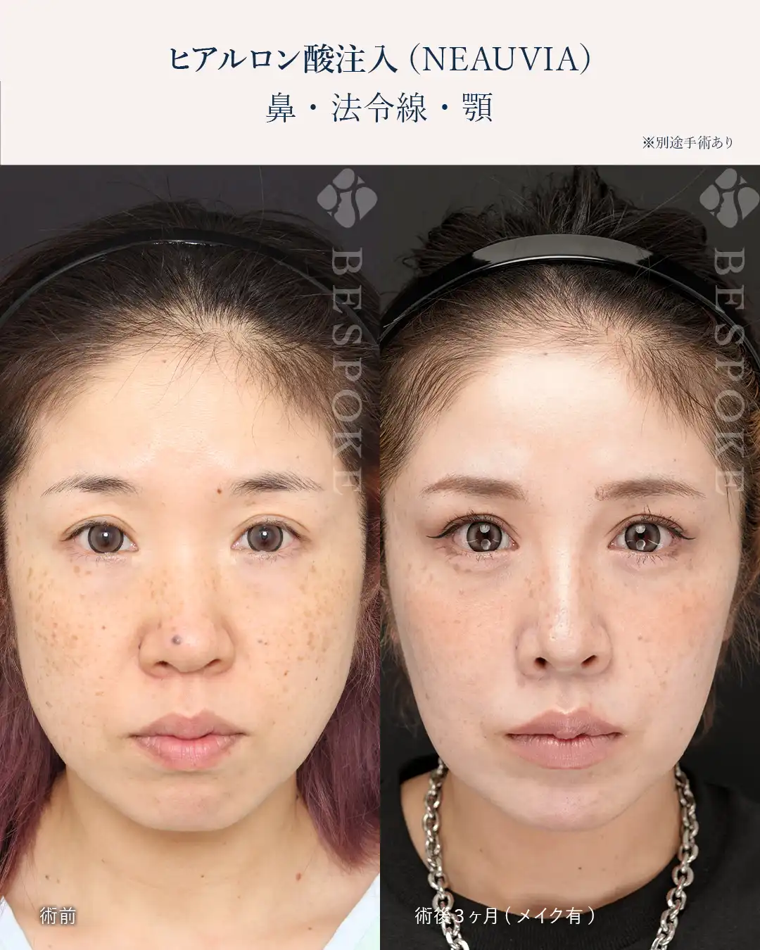 【NEAUVIA】ヒアルロン酸３本で手術級の効果を