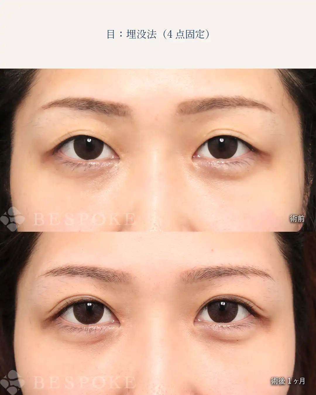 【二重埋没法】目元のたるみによって浅くなった二重ラインを元に戻す