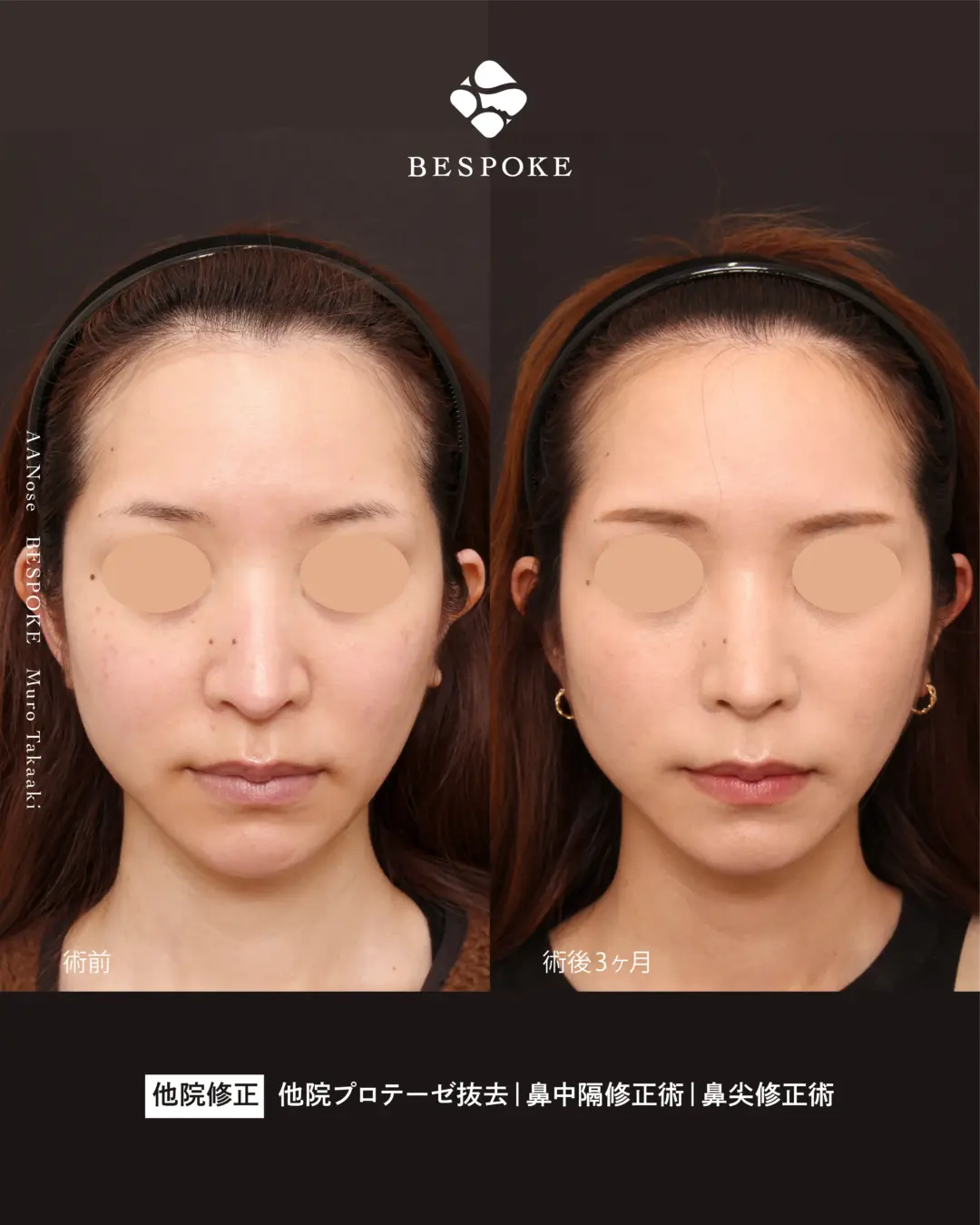 【AA Nose】「鼻整形をしたら老けちゃった」を、直す