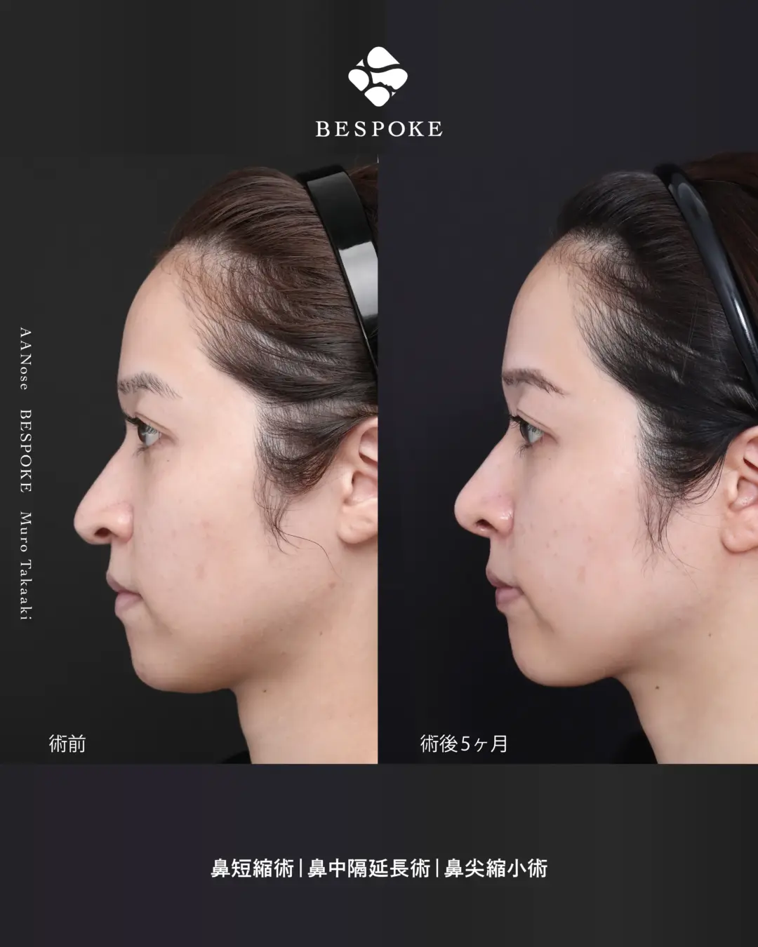 【AA Nose】「長くて曲がった鼻先」を、若返らせる