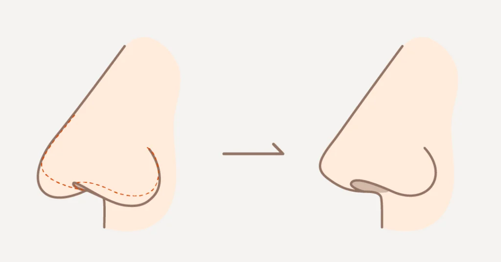 アンチエイジング_3つのポイント_中顔面が長くなる原因のイラスト