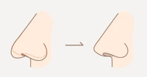 鼻整形による若返りアンチエイジングノーズのイメージ図