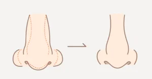 鼻整形による若返りアンチエイジングノーズのイメージ図