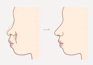鼻整形による若返りアンチエイジングノーズのイメージ図