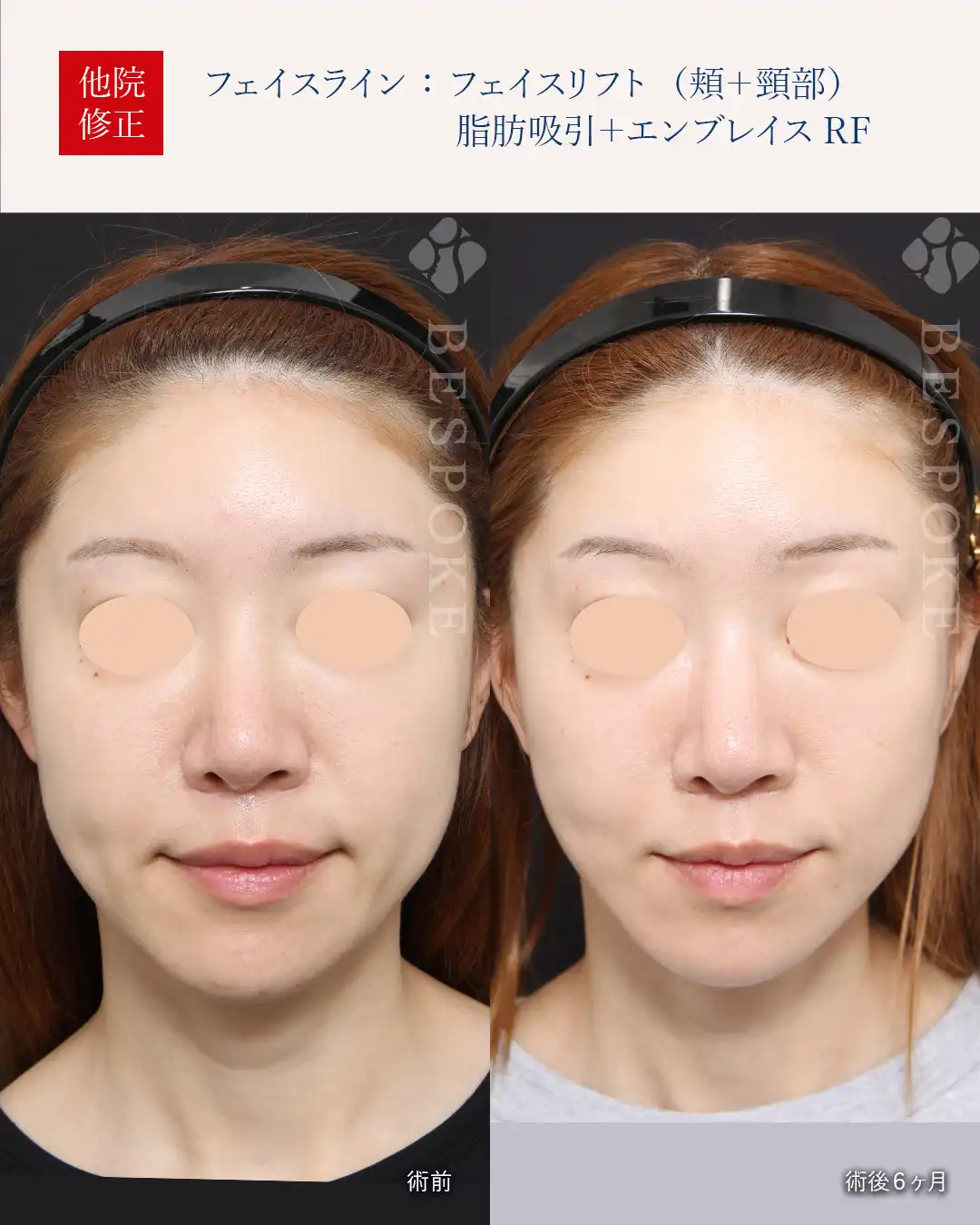 【エンブレイス】脂肪吸引後の凹つき、たるみを引き締める