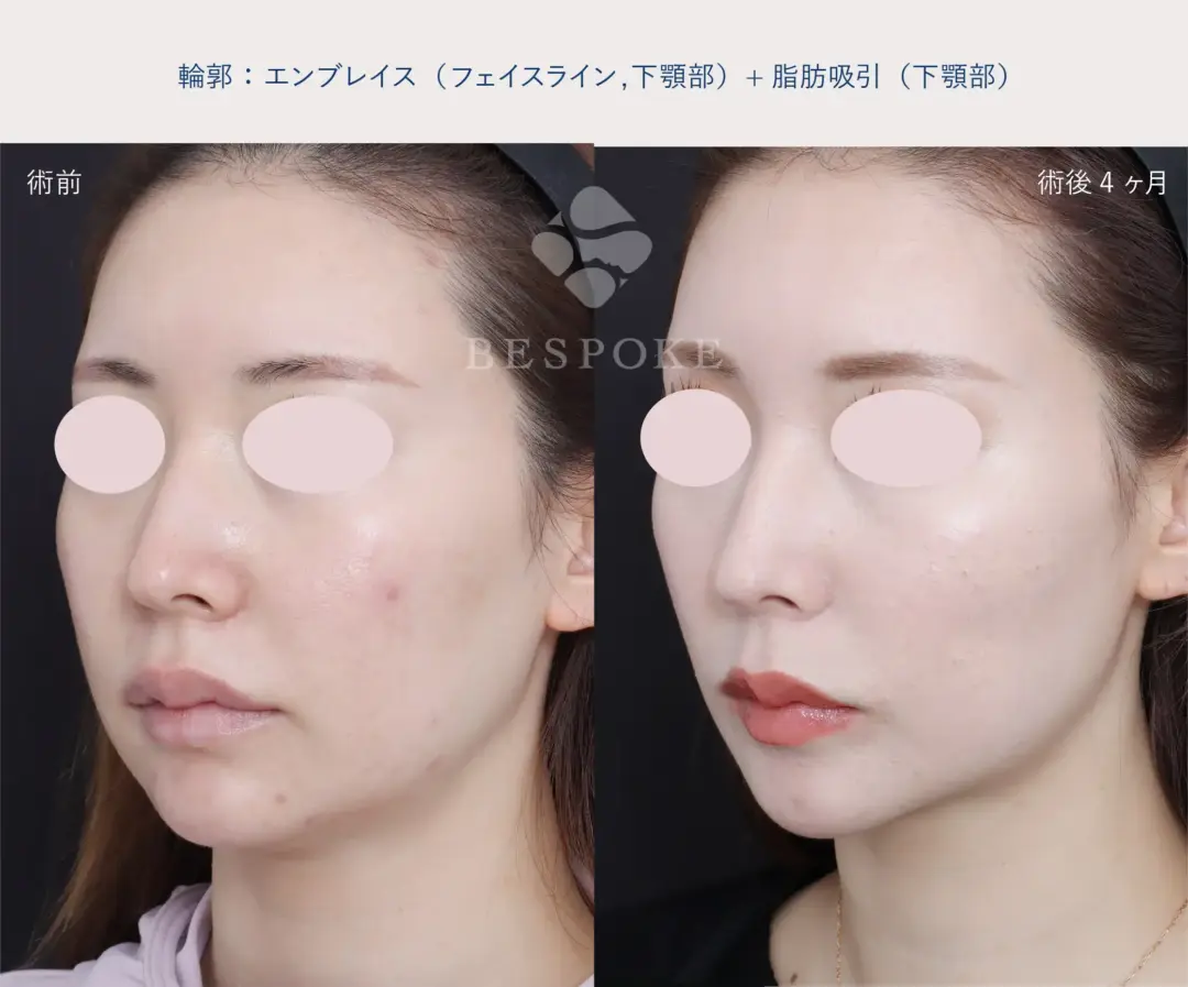 エンブレイスと脂肪吸引の症例写真