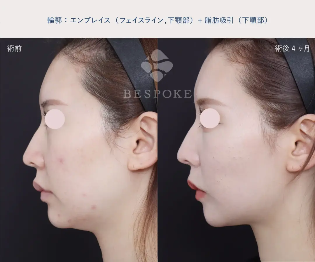 エンブレイスと脂肪吸引の症例写真