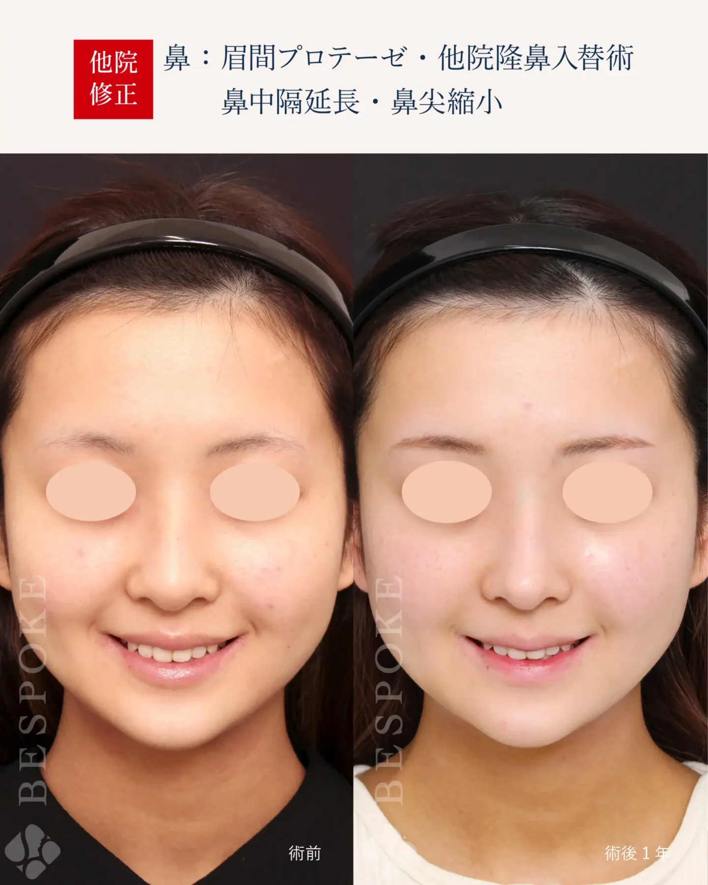 眉間プロテーゼ、隆鼻術、鼻中隔延長術、鼻尖縮小術の症例