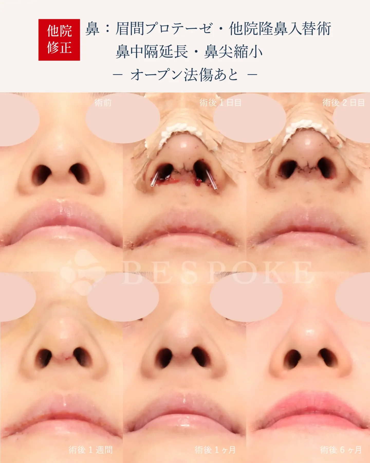 眉間プロテーゼ、隆鼻術、鼻中隔延長術、鼻尖縮小術の傷跡