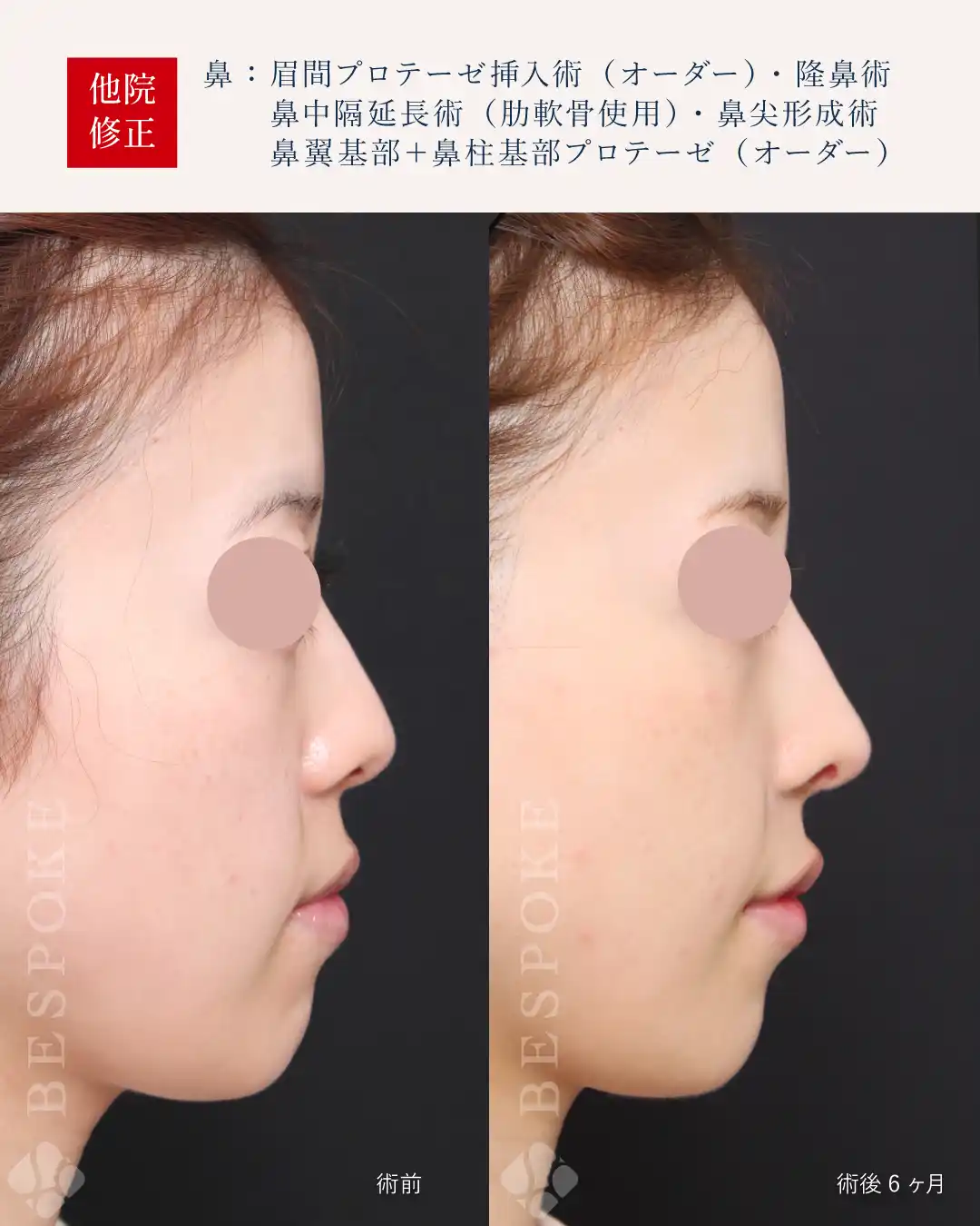 【鼻】鼻の歪みと口元のバランスを整える