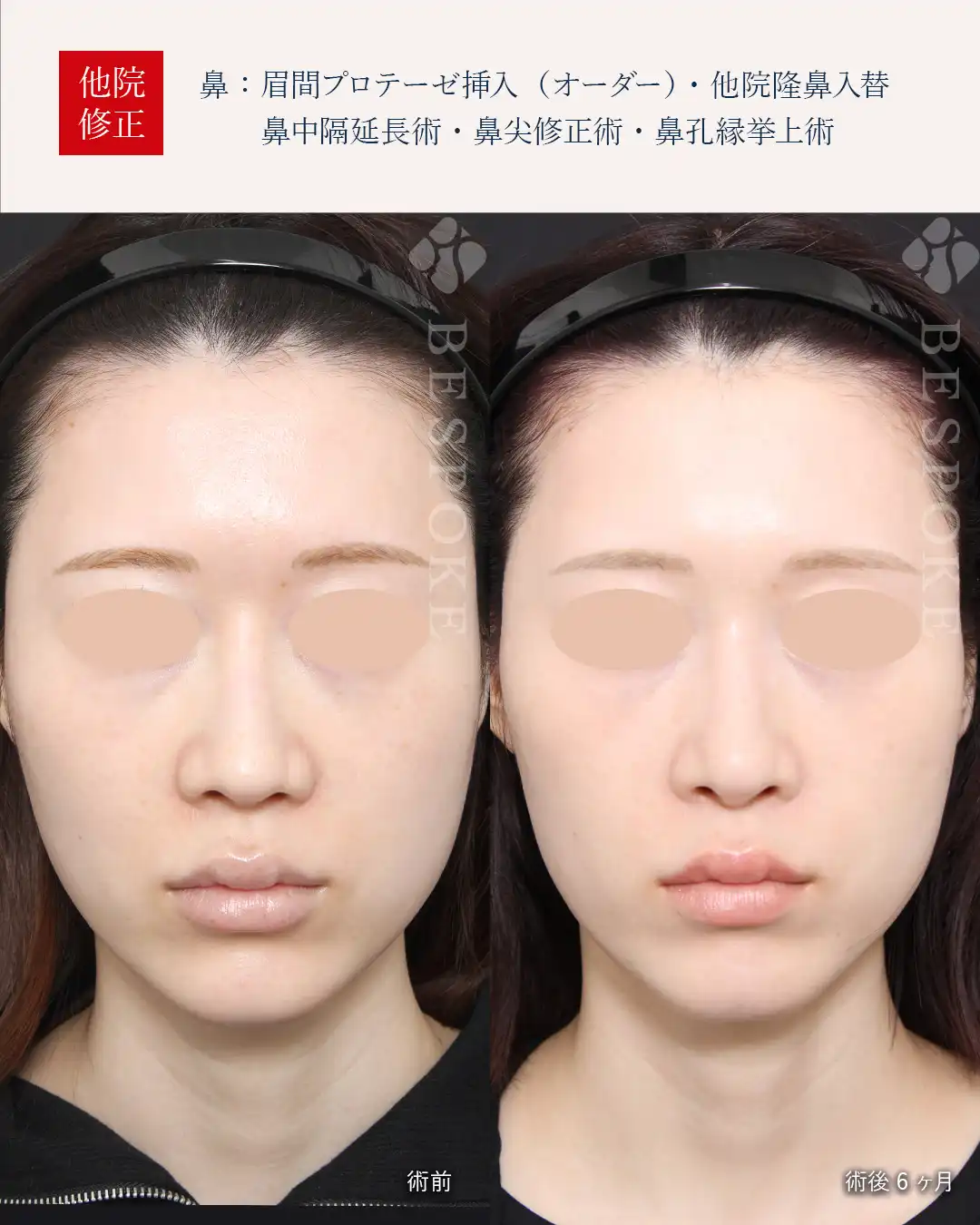 面長顔と大きな鼻を改善する手術