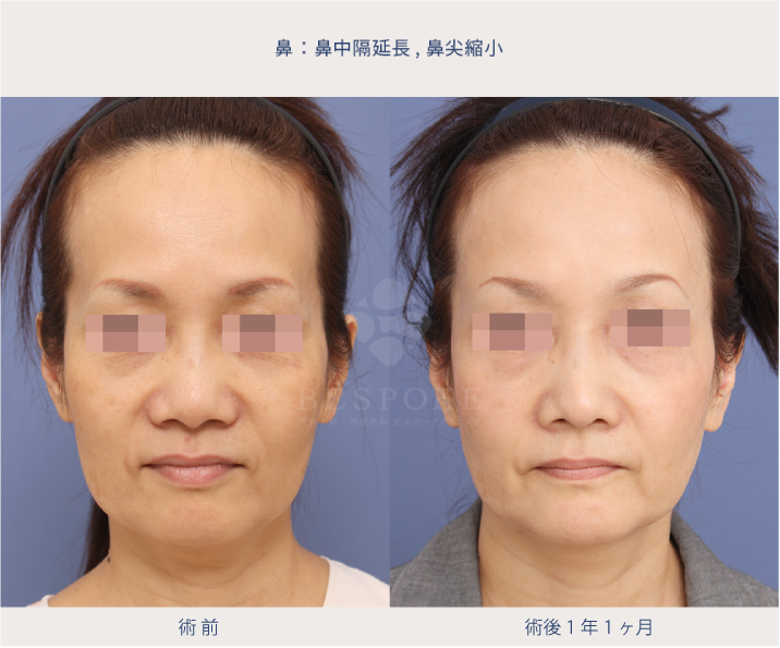 鼻整形による若返りアンチエイジングノーズの症例