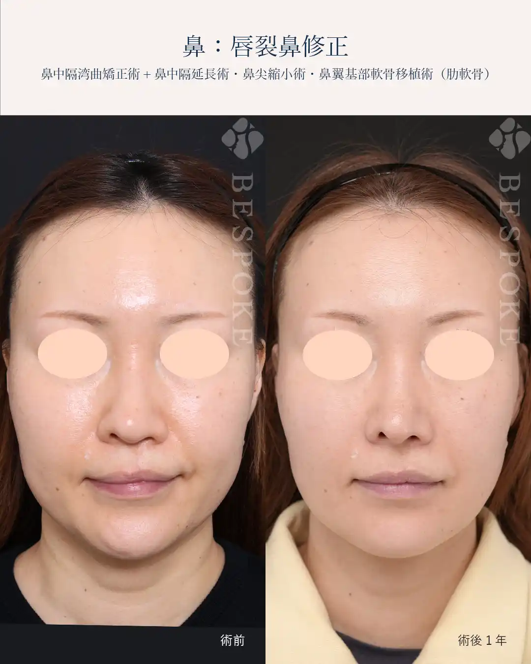 形成外科の知見を活かした唇裂鼻の手術