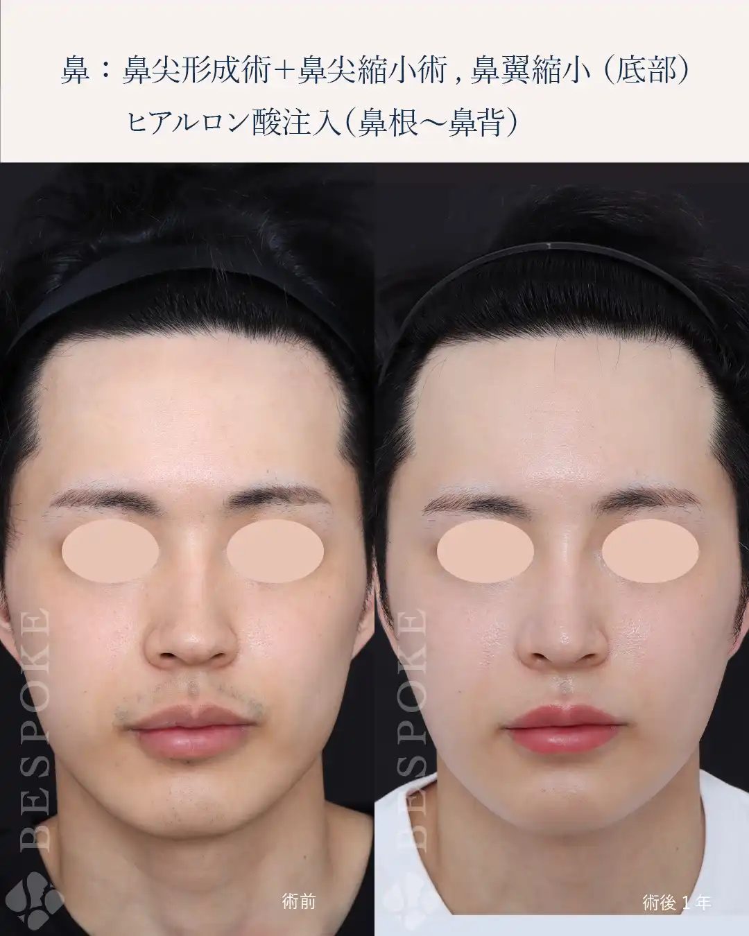 【鼻】男性らしさを損なわず、自然な仕上がりで鼻を小さく見せる