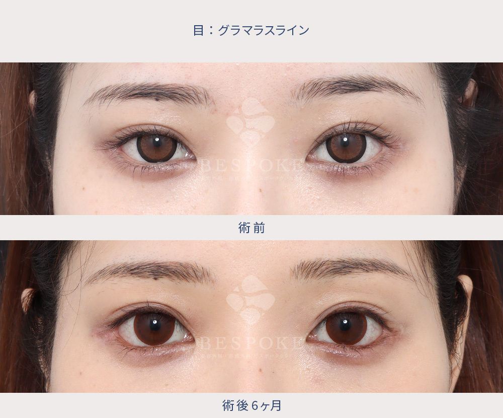 【鍵穴式眼瞼下垂術＋グラマラスライン形成＋目尻切開】ツリ目な一重さんを、丸みのある愛らしい目元に