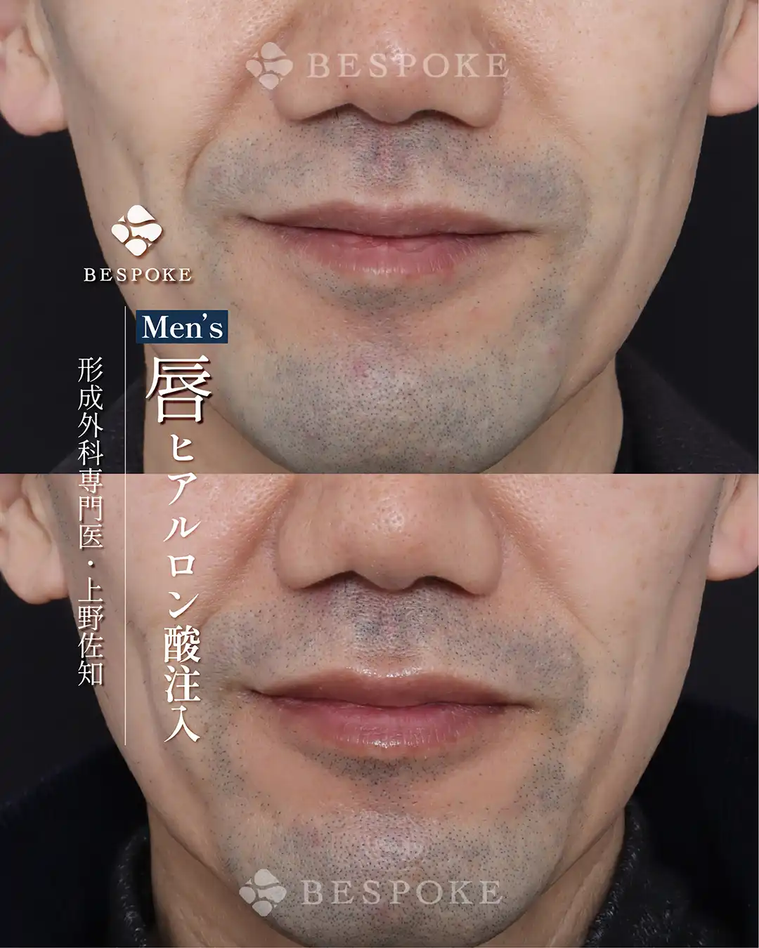 【ヒアルロン酸注入(口唇)】男性も、柔らかで若々しい印象の口元へ