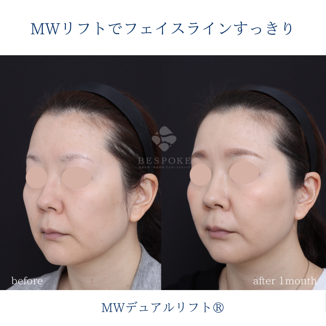 糸リフト