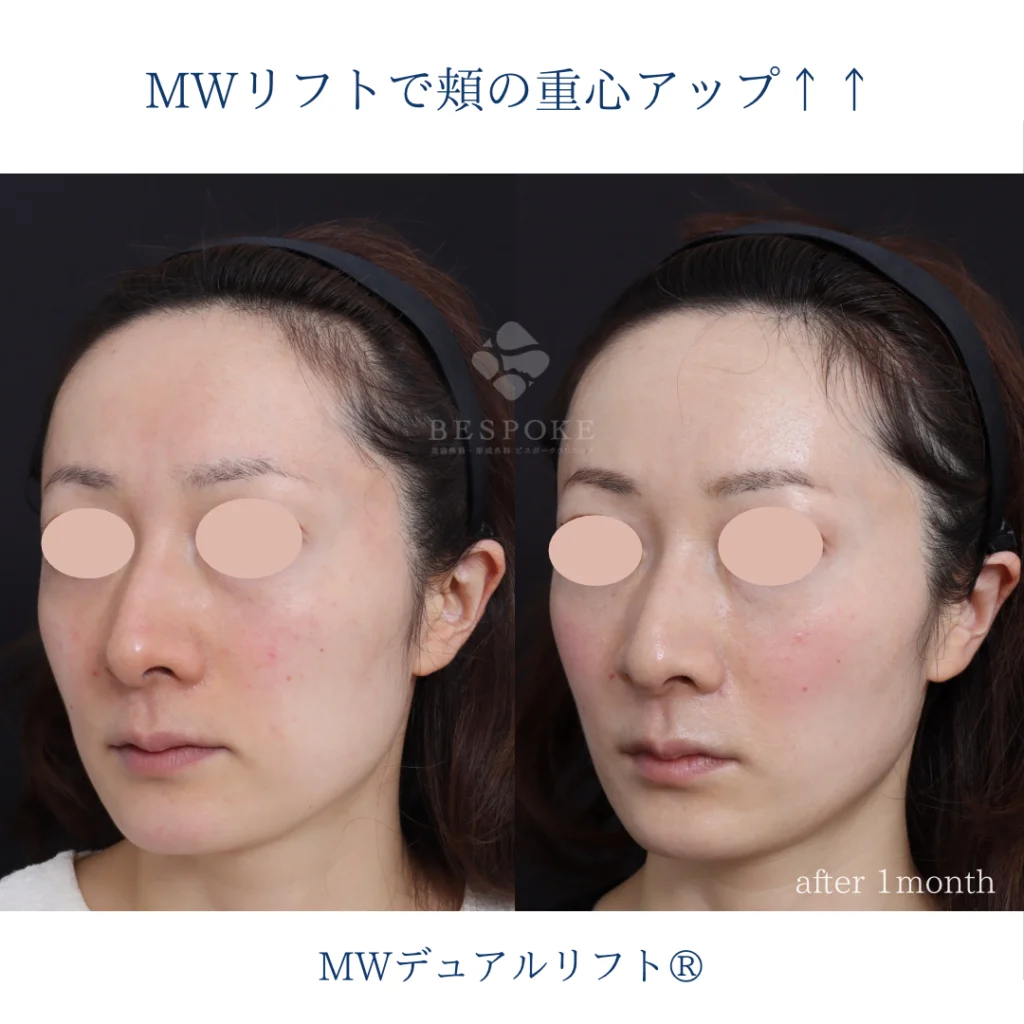 糸リフト