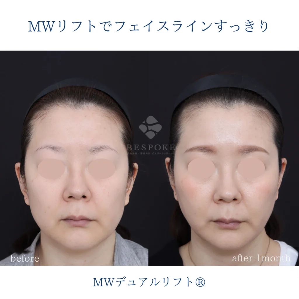 糸リフト