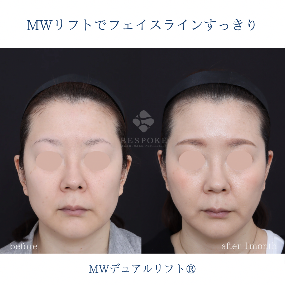 【MWデュアルリフト®】糸リフトでフェイスラインすっきり