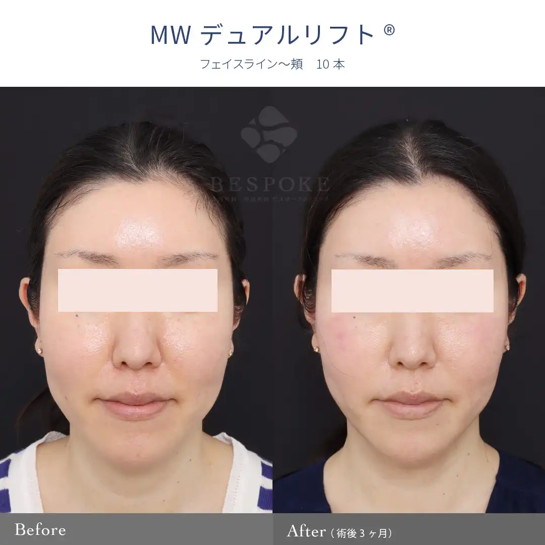 【MWデュアルリフト®】頬の位置を上げて、下膨れ顔を改善。
