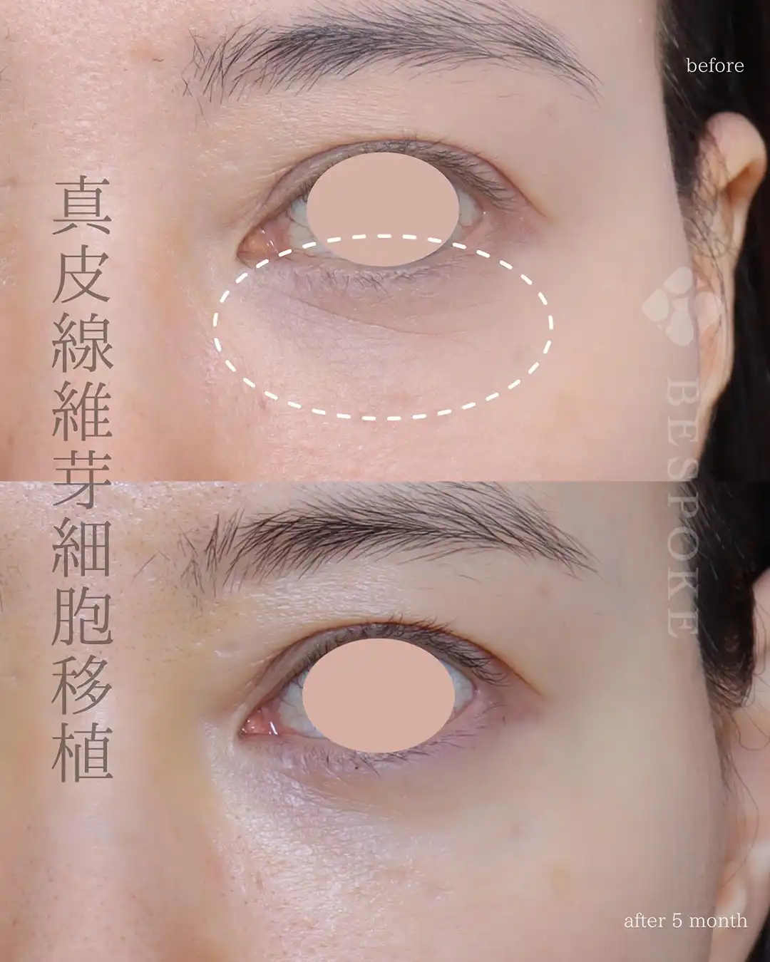 【真皮線維芽細胞移植術】目元の小じわへの最適解。