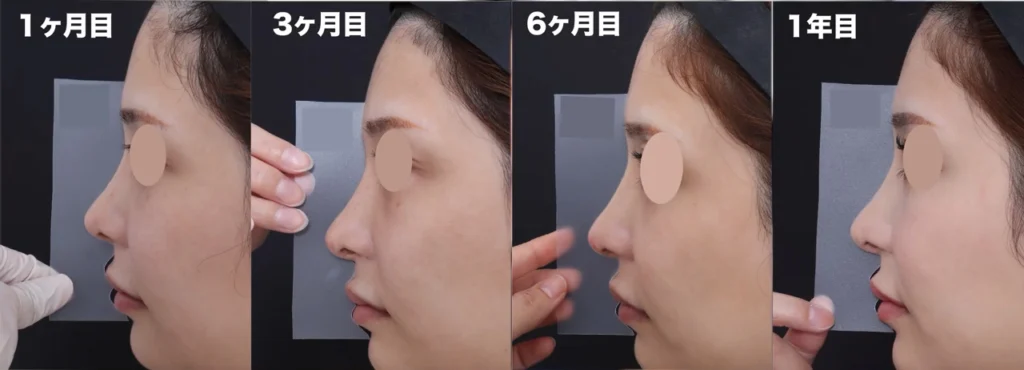 テンプレートサージャリーの型合わせ経過