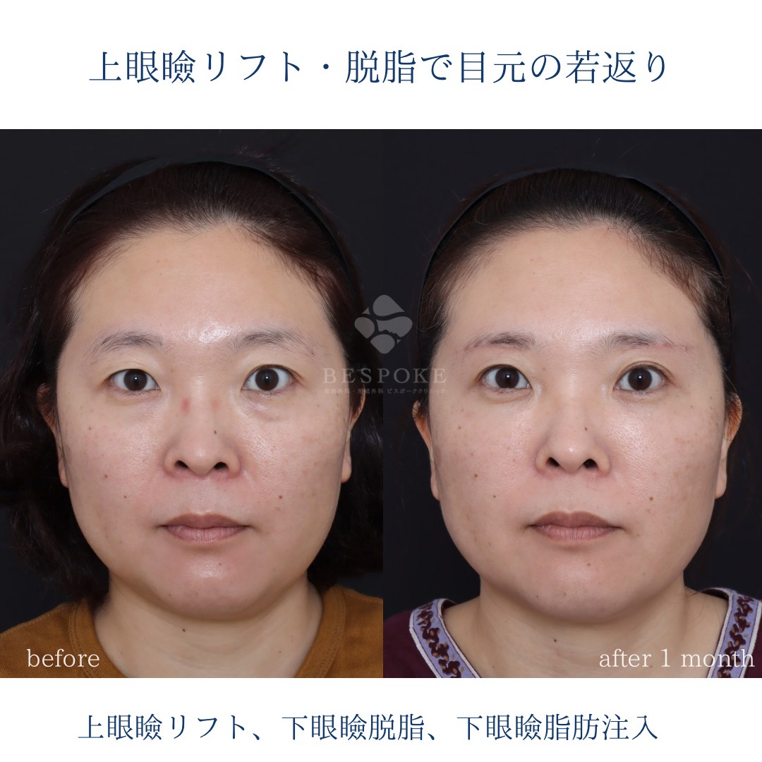 【上眼瞼リフト＋下眼瞼脱脂・脂肪注入】目元のたるみからくる左右差を改善。