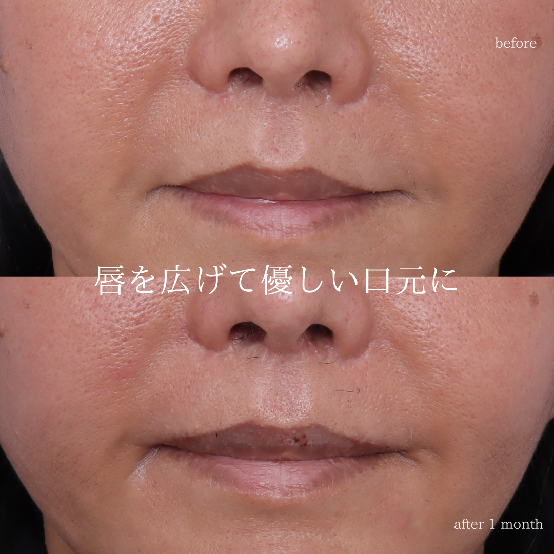 【口角挙上術＋口唇拡大術】くちびるを広げて優しい印象に。