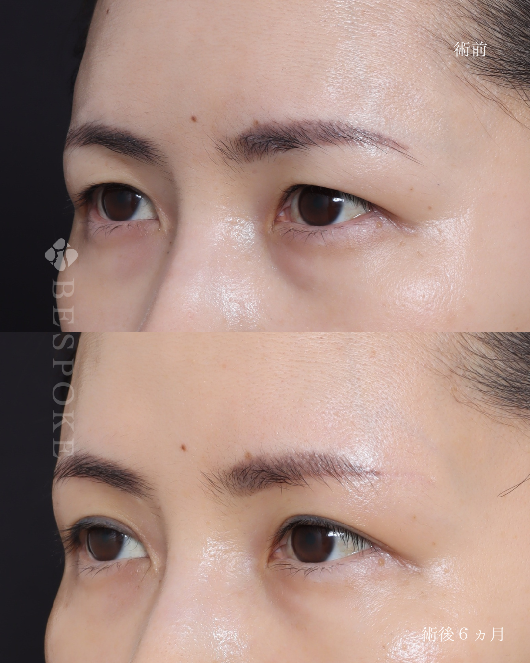 【上眼瞼リフト＋ベビーコラーゲン注入】瞼の重みと目の下のクマを解消