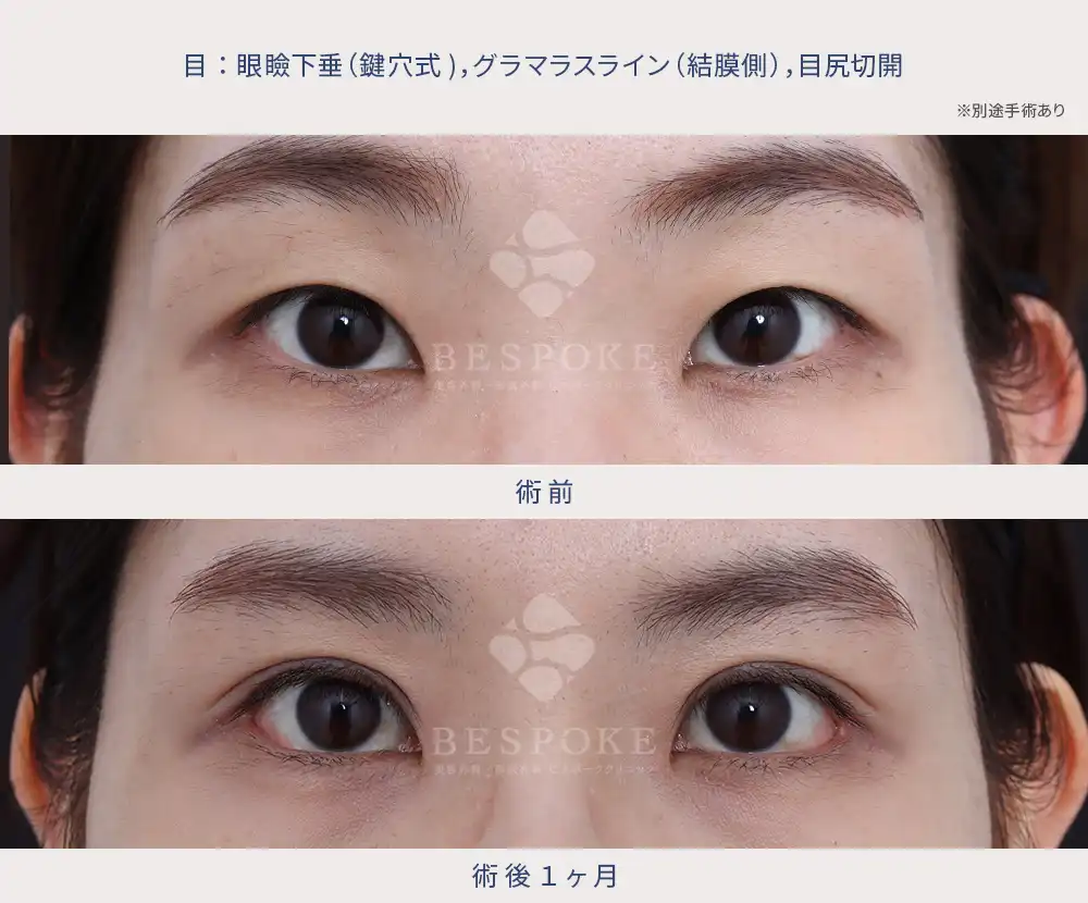 【鍵穴式眼瞼下垂術＋グラマラスライン形成＋目尻切開】ツリ目な一重さんを、丸みのある愛らしい目元に