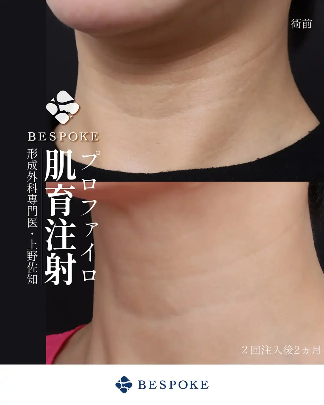 【肌育注射】首元のしわを改善する、プロファイロという選択肢