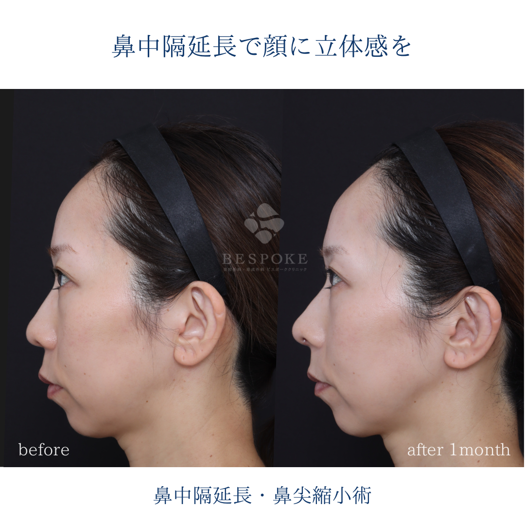 【鼻中隔延長術＋鼻尖縮小術】横から見た時の鼻先の丸みを改善。