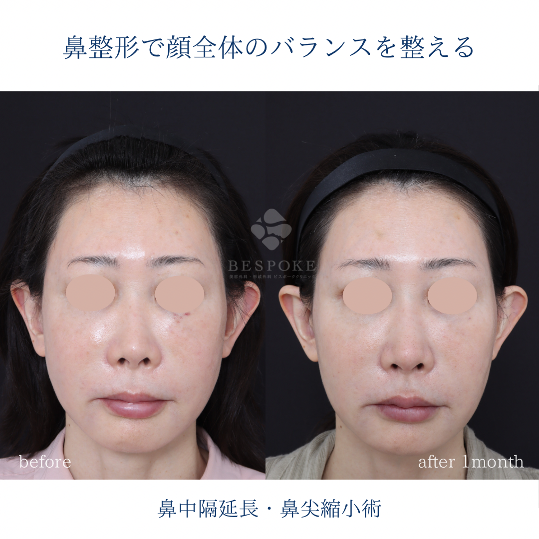 【鼻中隔延長術＋鼻尖縮小術】人中短縮効果のある鼻整形