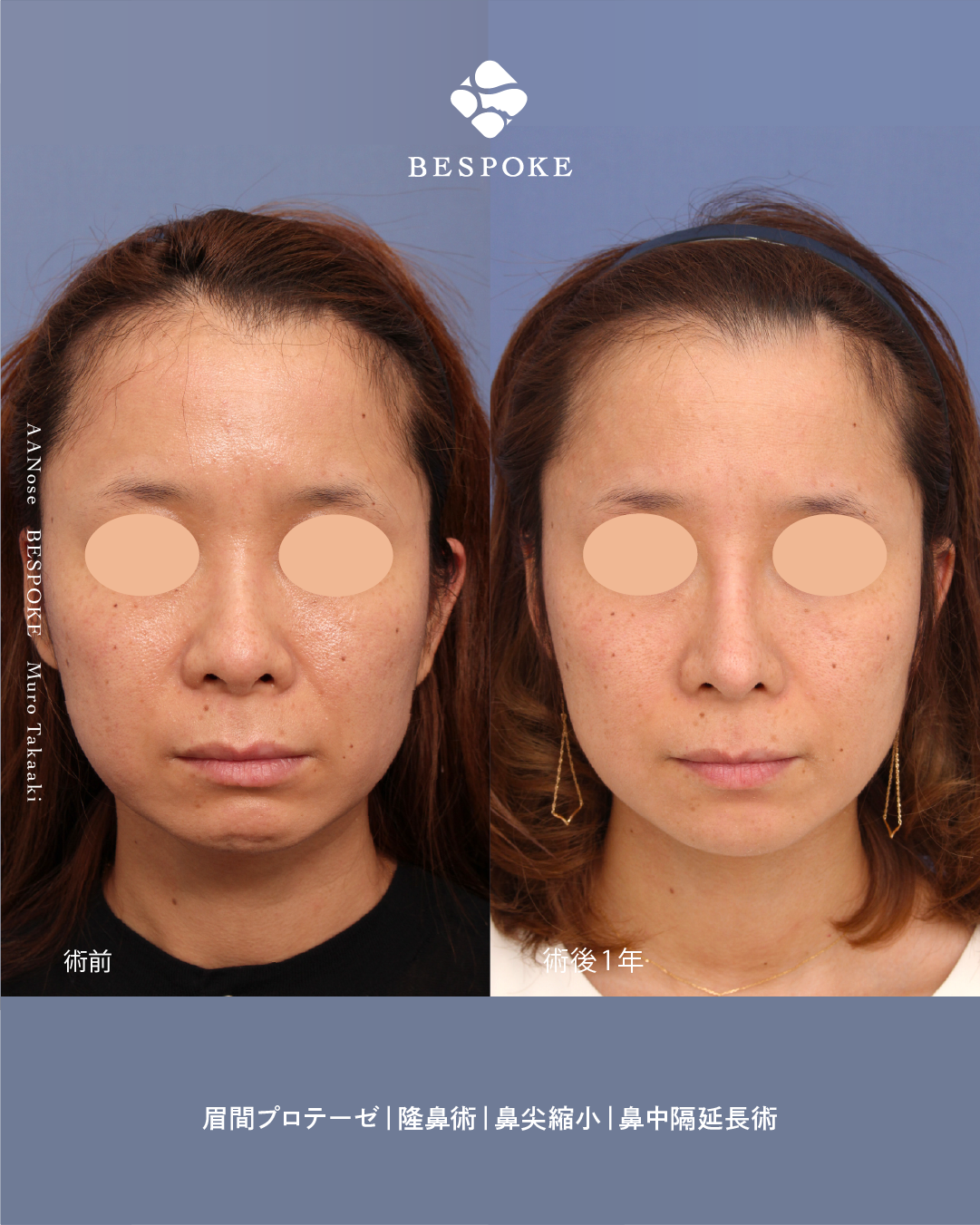 【鼻】ひとまわり小さく見せたい！を、叶える鼻整形。