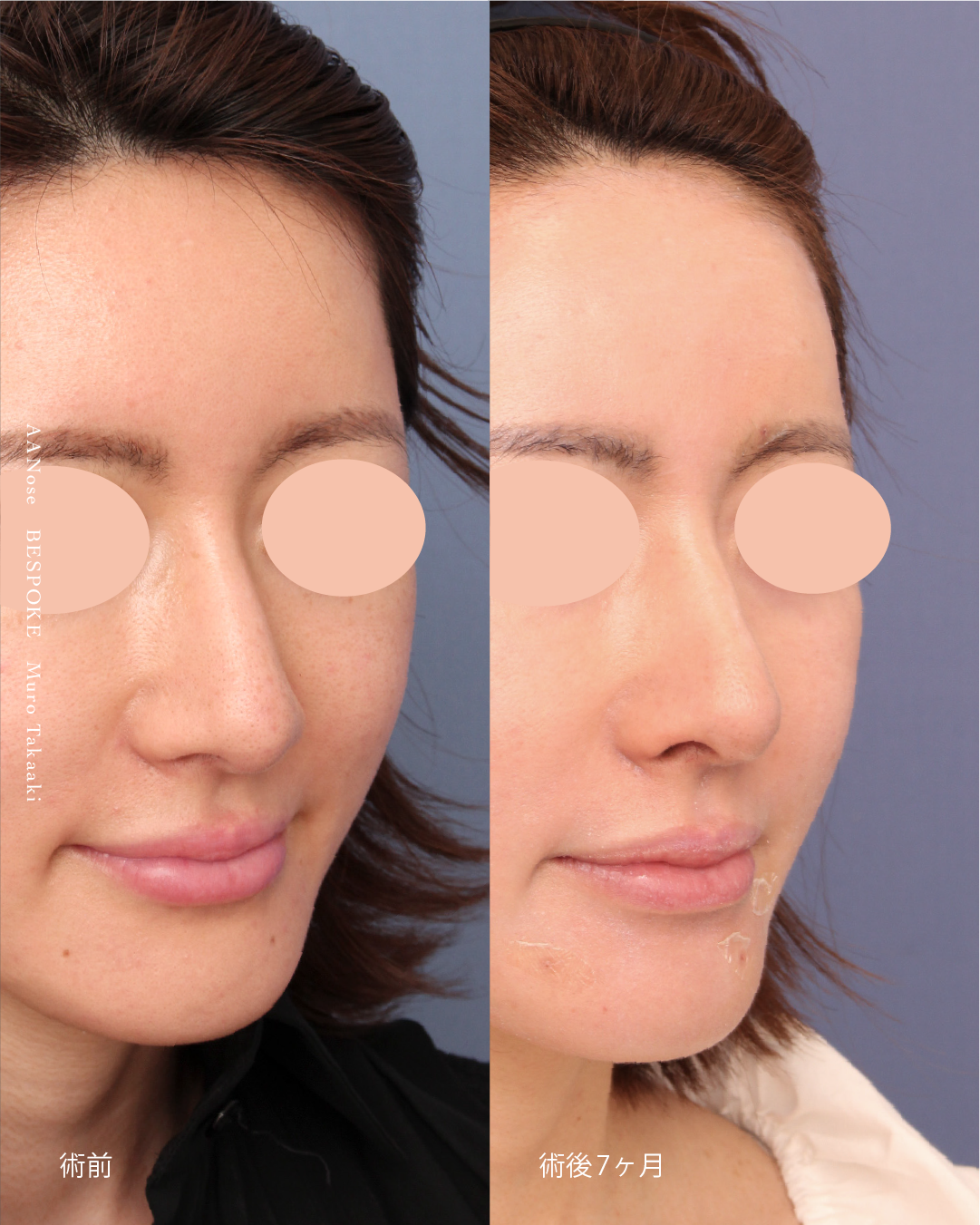 鼻骨骨削り、鼻短縮術、鼻中隔延長術、鼻尖縮小術、鼻孔縁挙上術のアンチエイジングノーズの症例