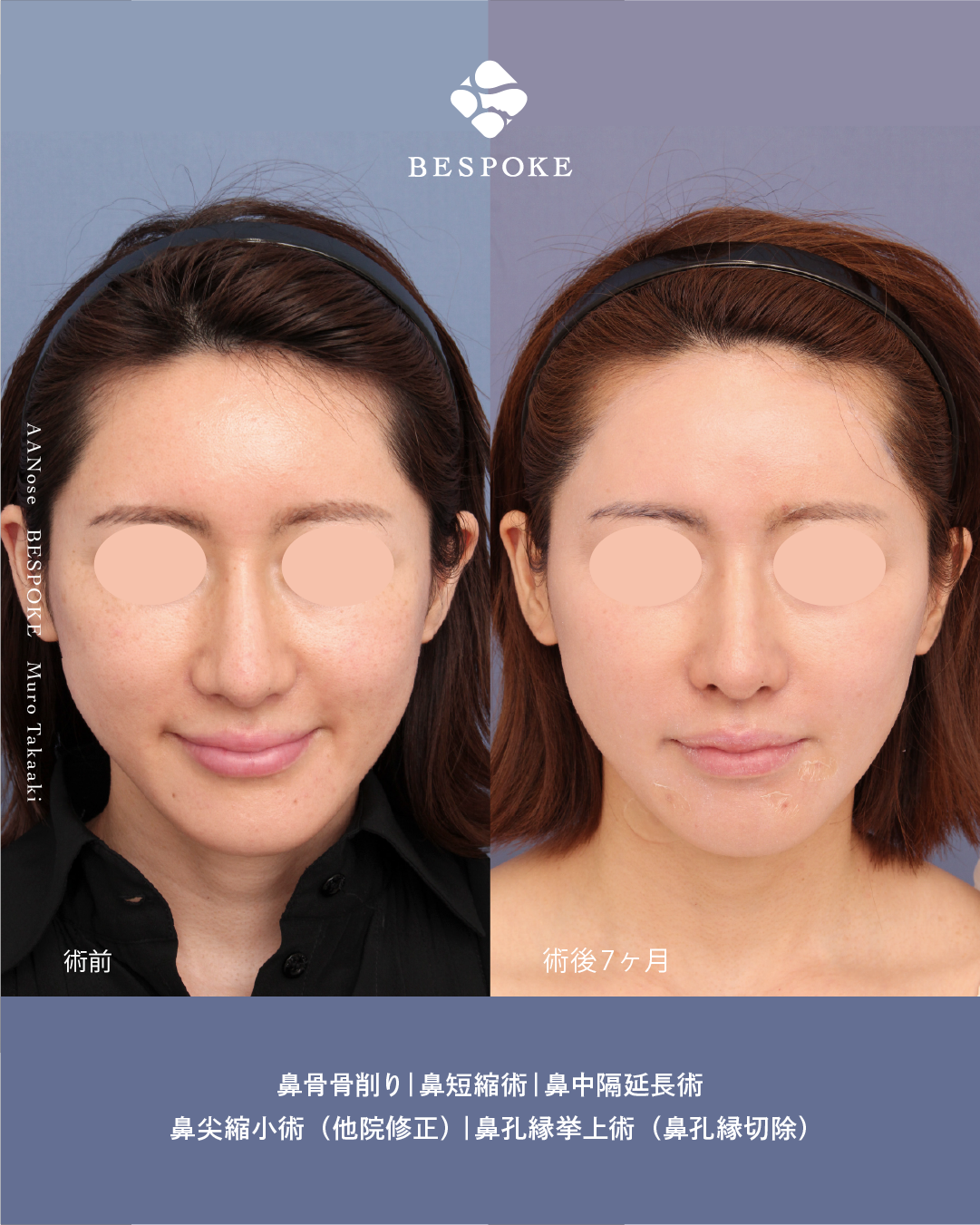 【鼻】鷲鼻と長さを、そっと控えめに。