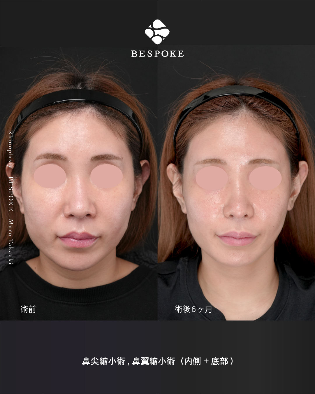 【鼻】小鼻を切らずに、自然に小さく