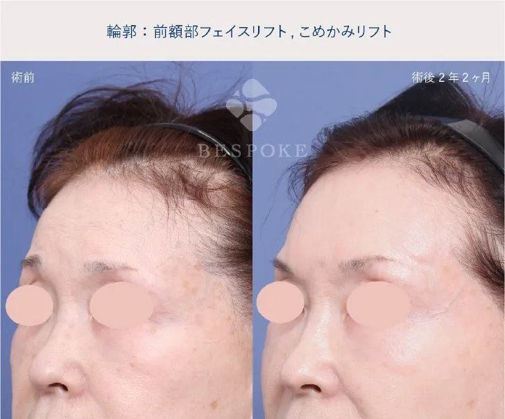前額リフトの女性の症例